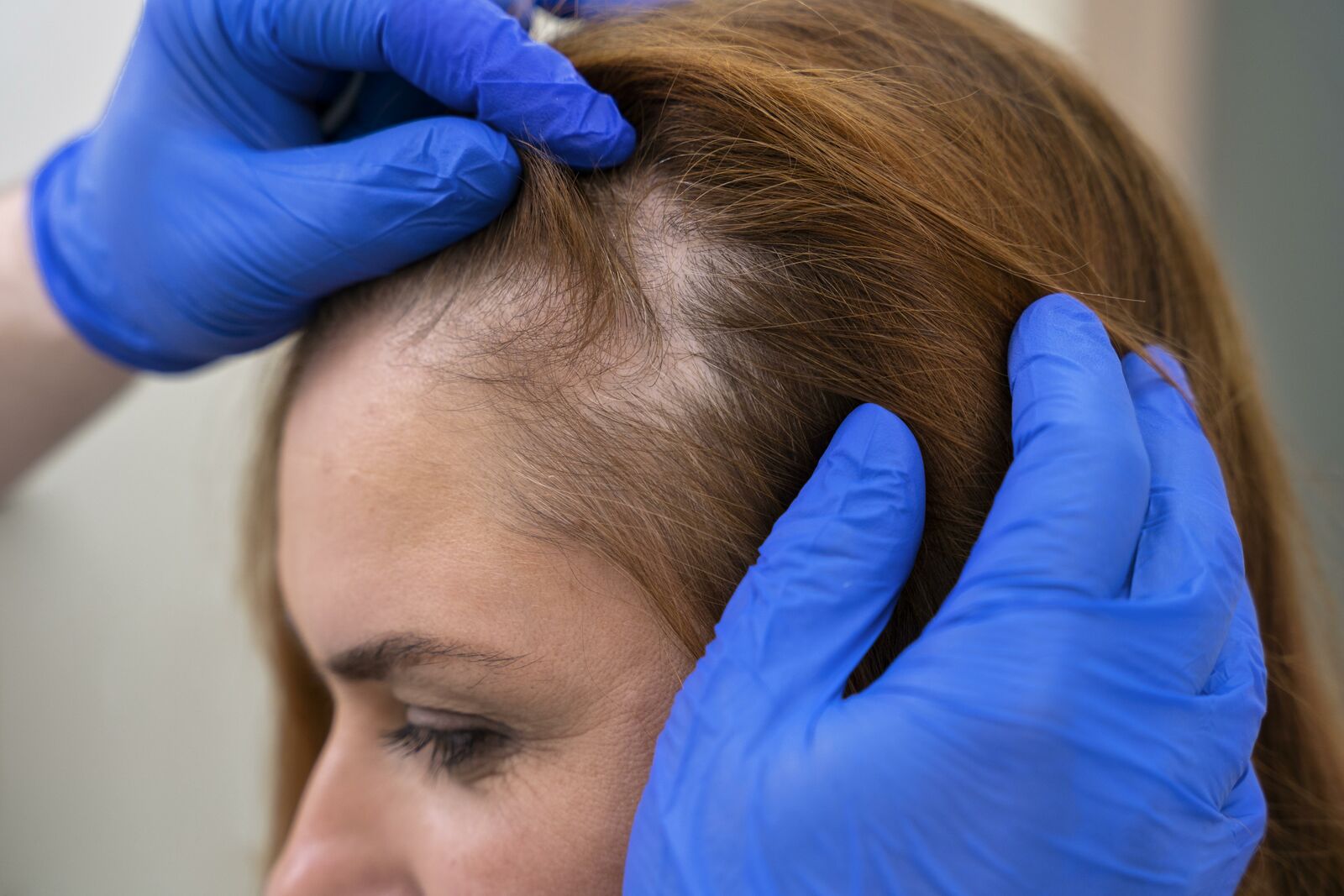 Alopecia Areata treatment at Derma Essence Noida