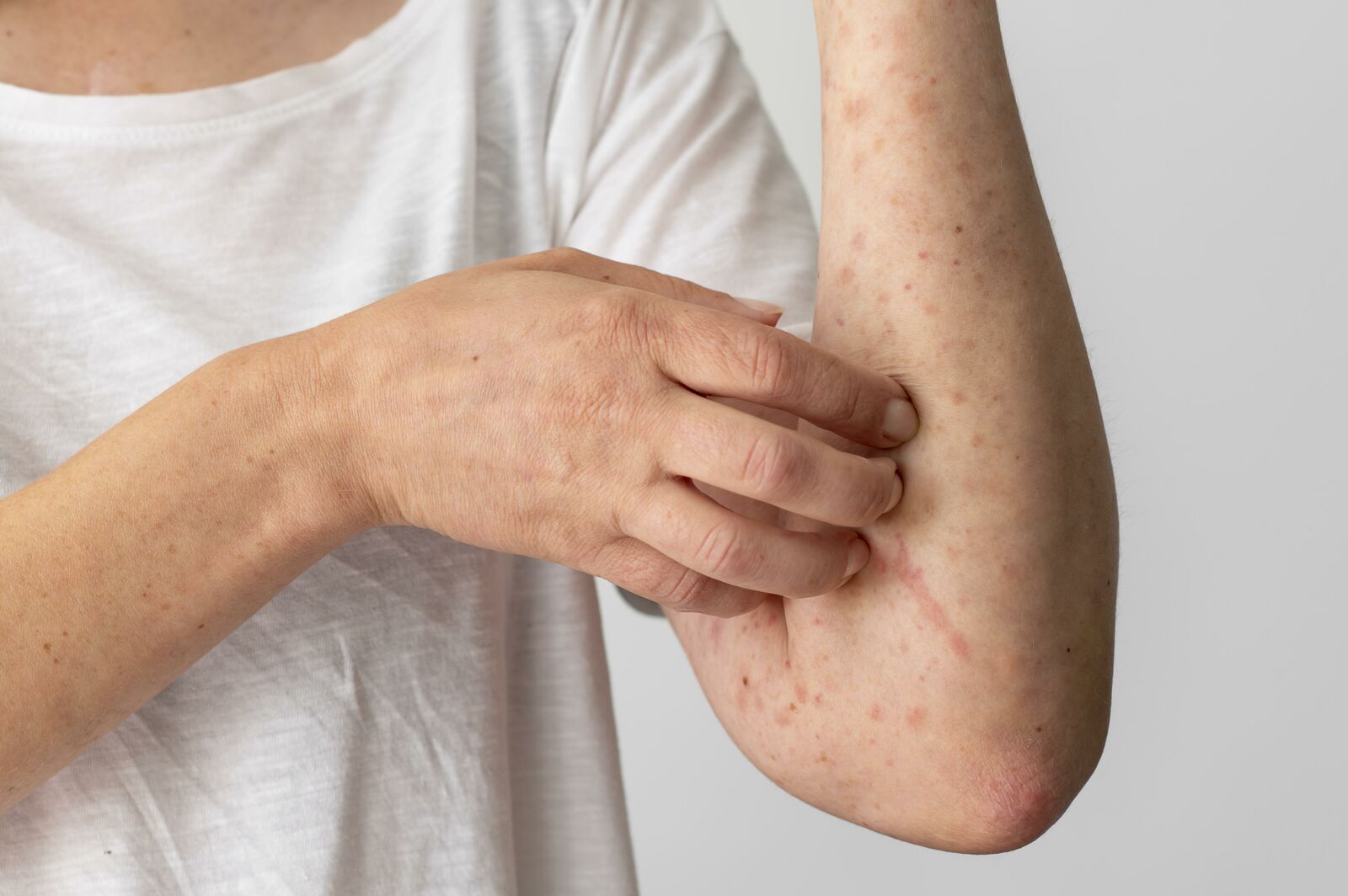 Atopic Dermatitis treatment at Derma Essence Noida