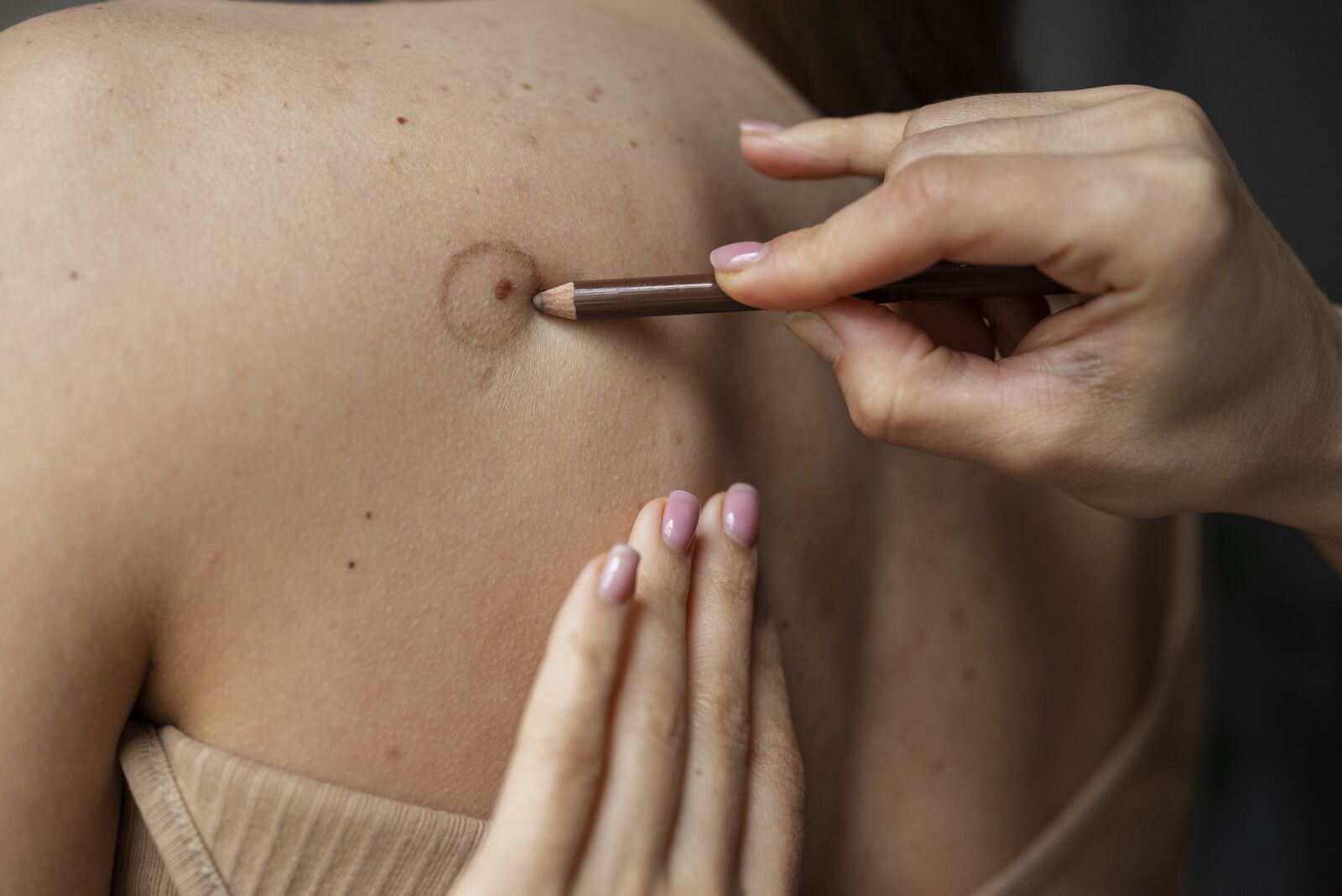 Birthmarks treatment at Derma Essence Noida