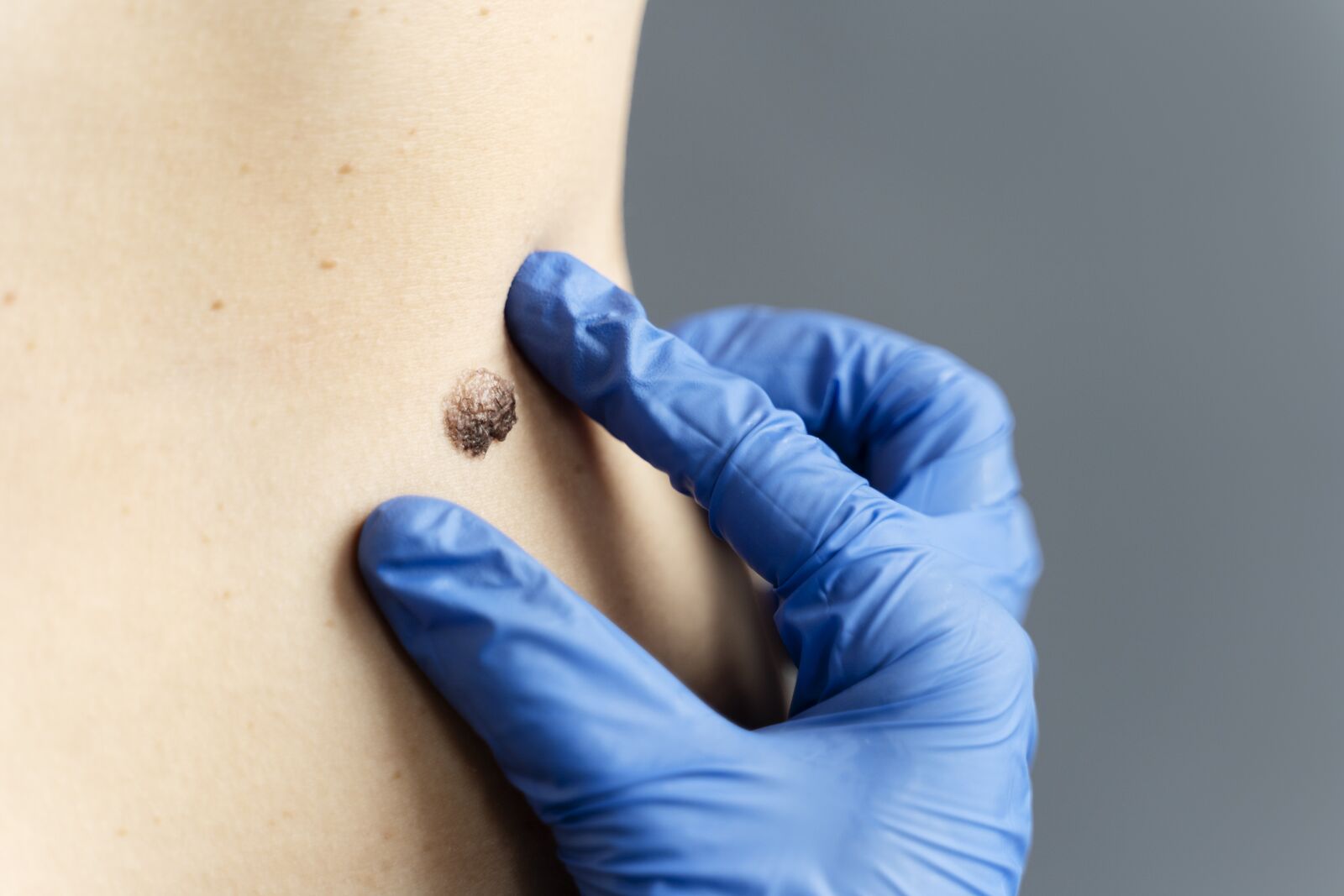 Cyst Removal treatment at Derma Essence Noida