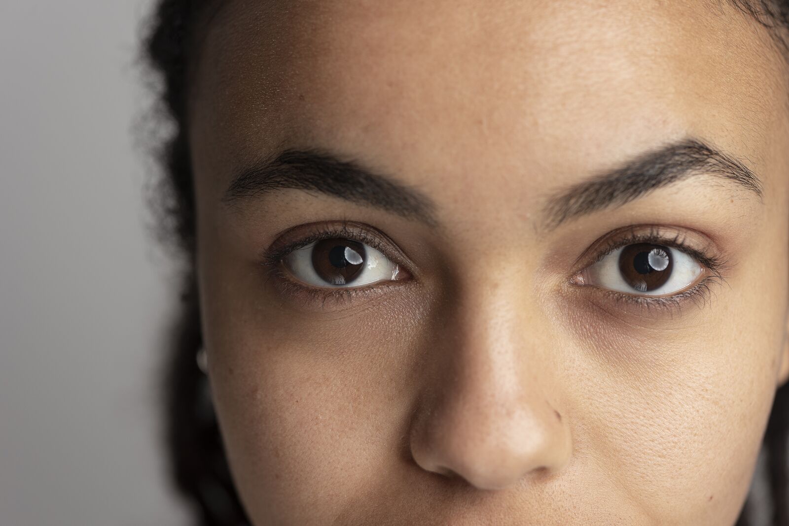 Dark Circles treatment at Derma Essence Noida