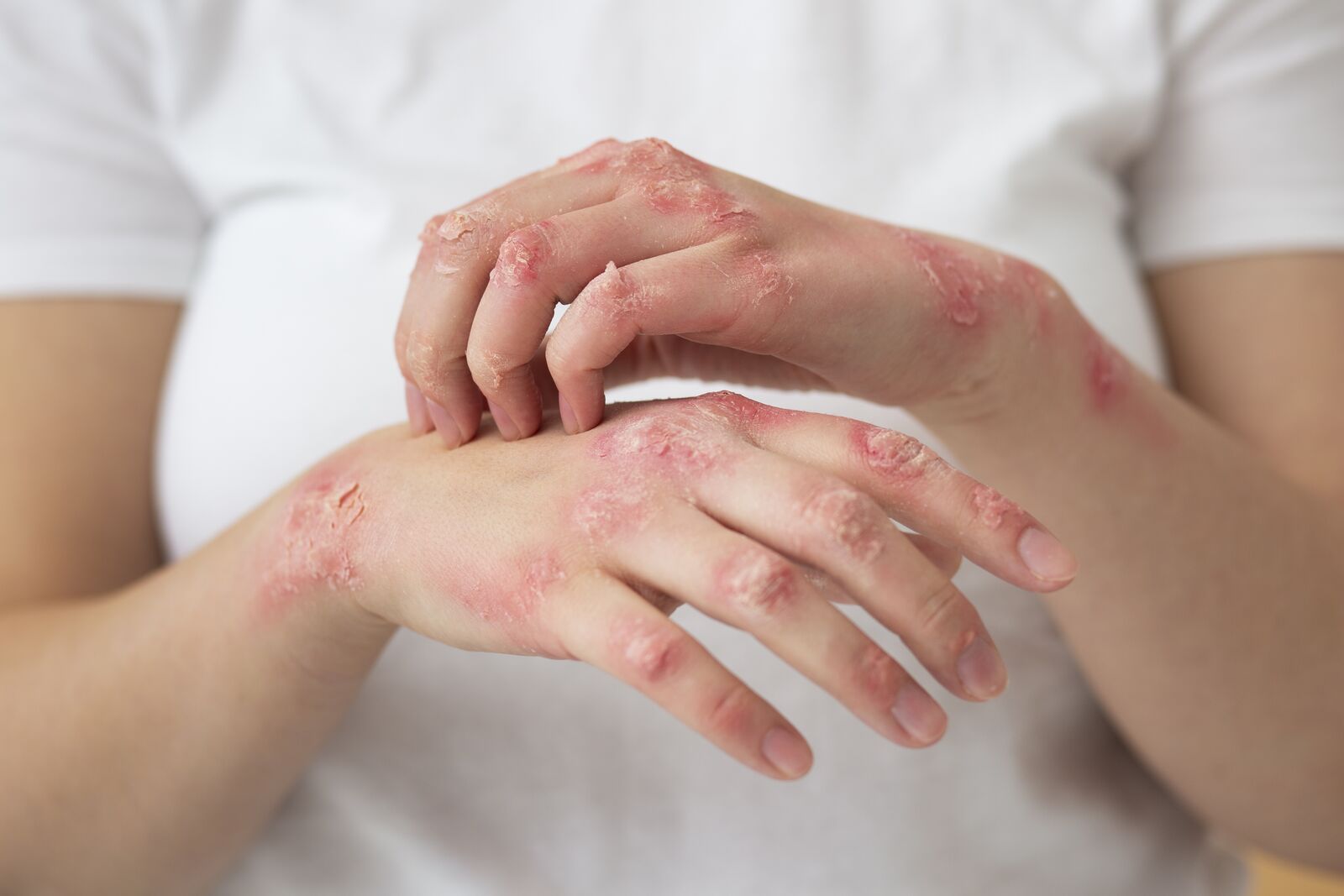 Eczema treatment at Derma Essence Noida