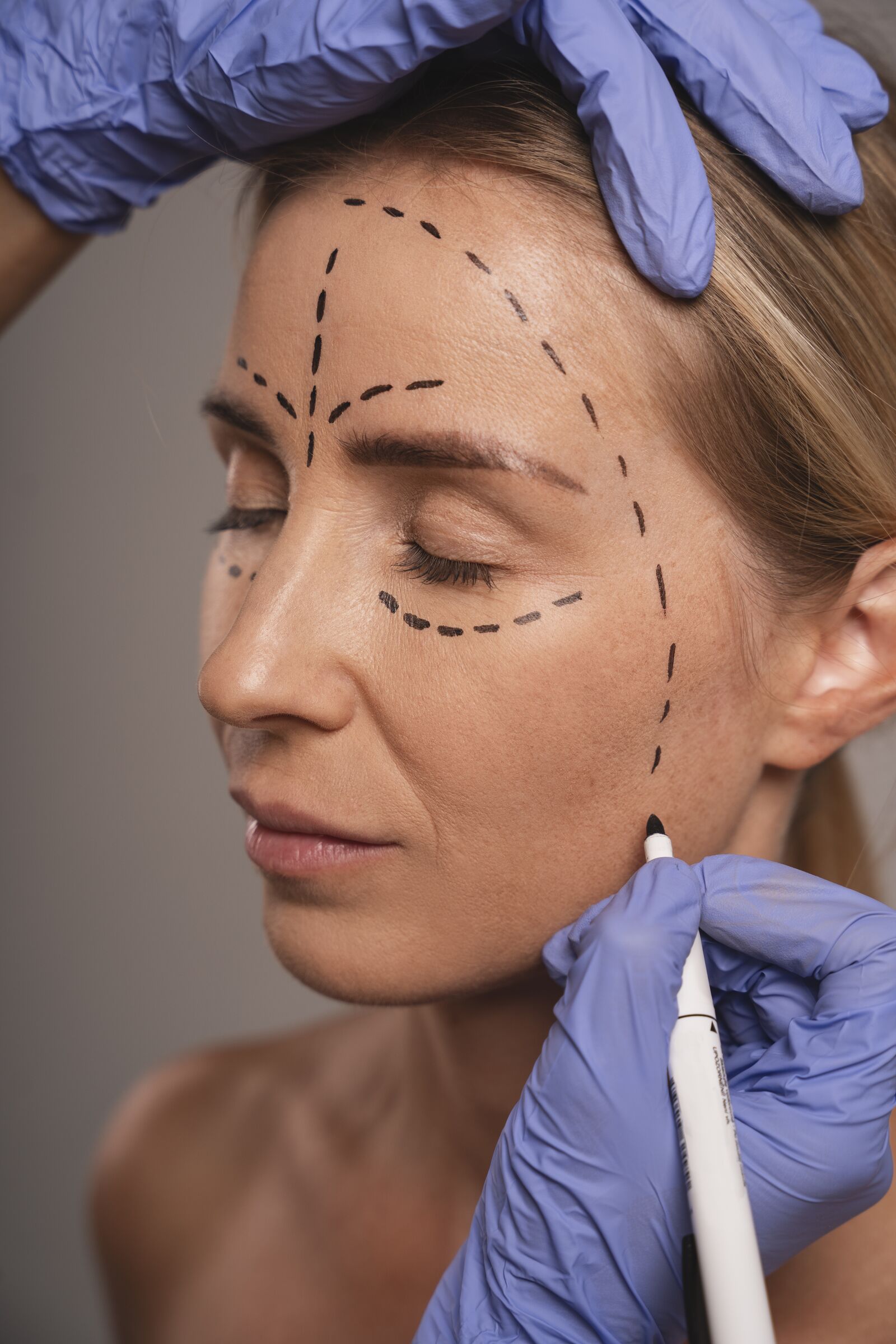 Facelift treatment at Derma Essence Noida
