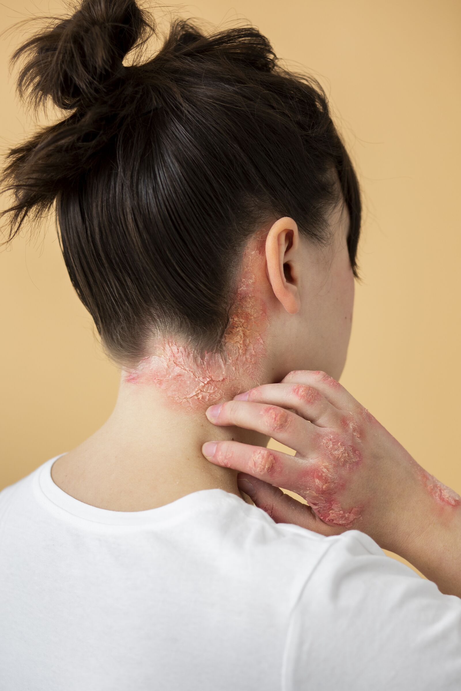 Fungal Infection treatment at Derma Essence Noida