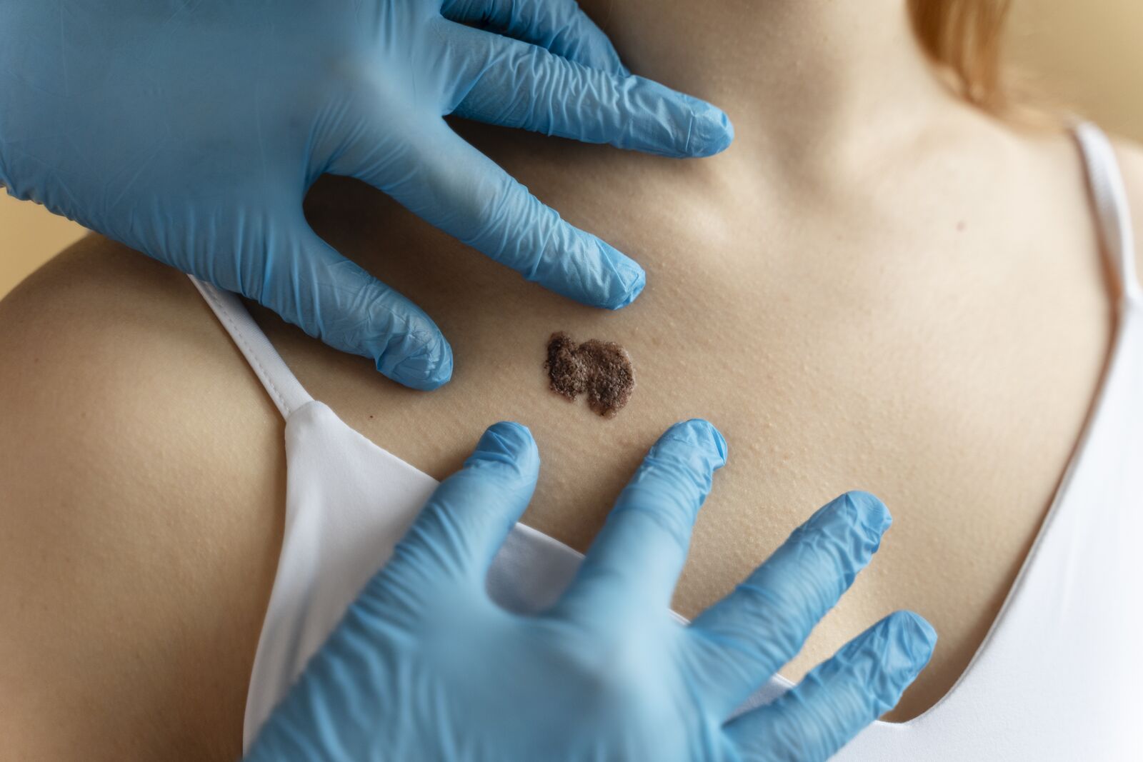 Keloid Removal treatment at Derma Essence Noida