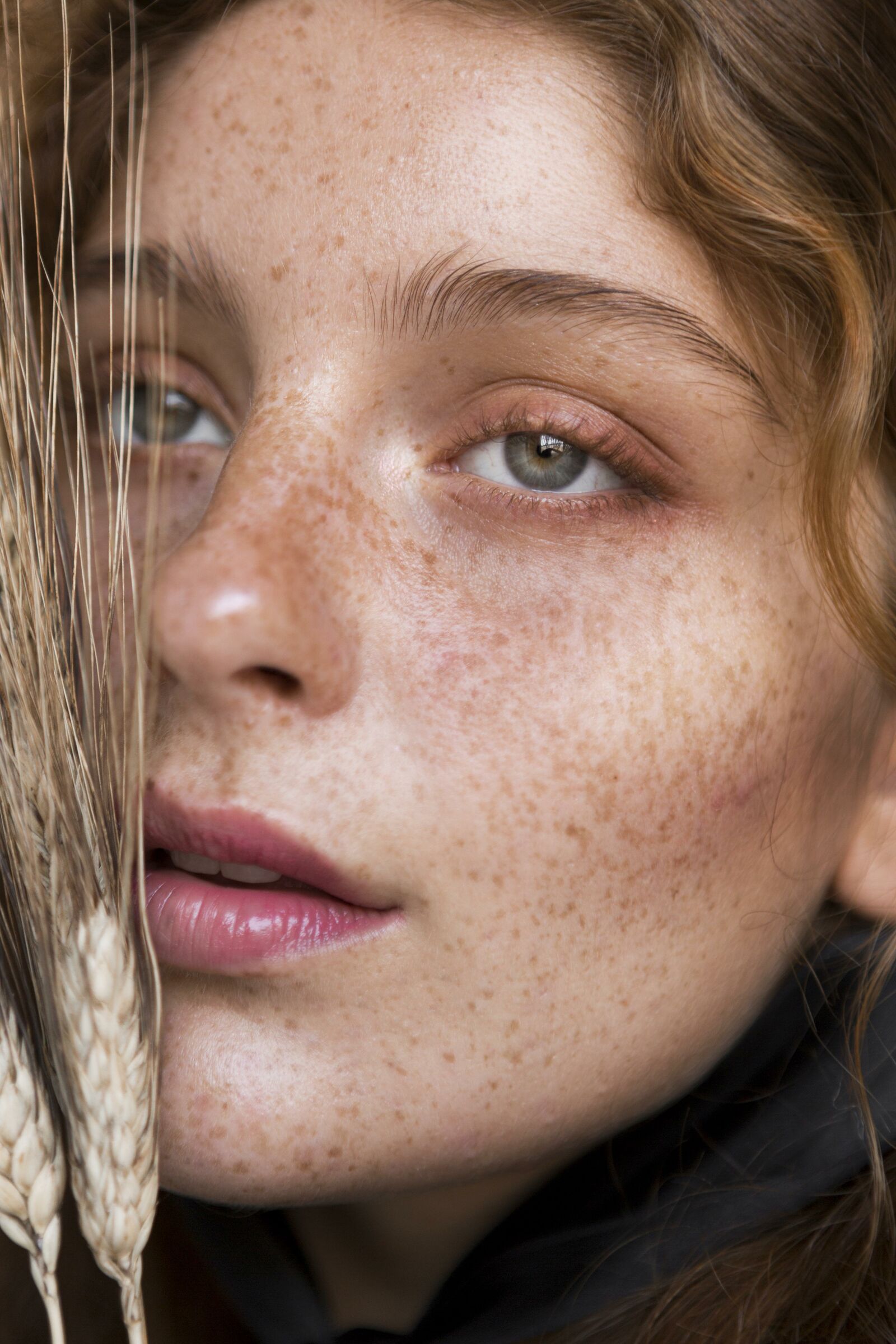 Melasma / Freckles treatment at Derma Essence Noida