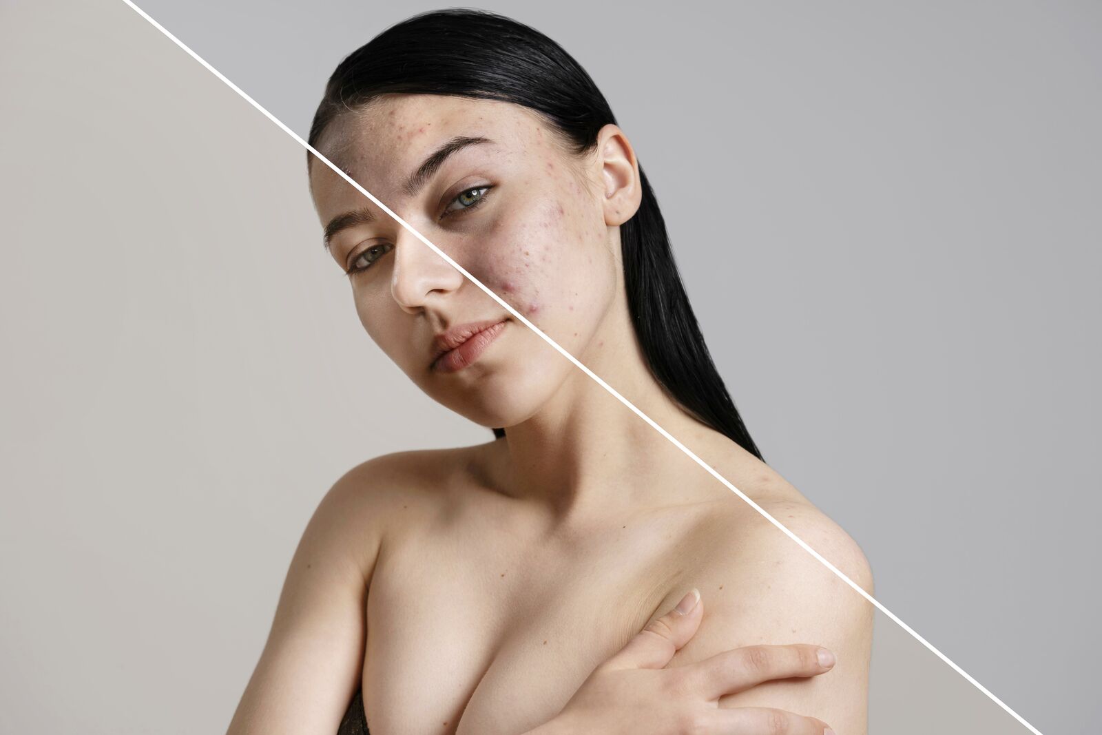 Microneedling Radiofrequency in Noida for Skin Rejuvenation & Scar Reduction treatment at Derma Essence Noida