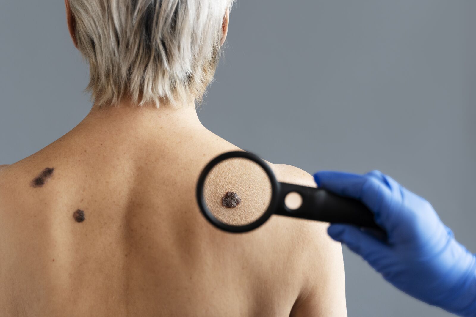 Mole Removal treatment at Derma Essence Noida