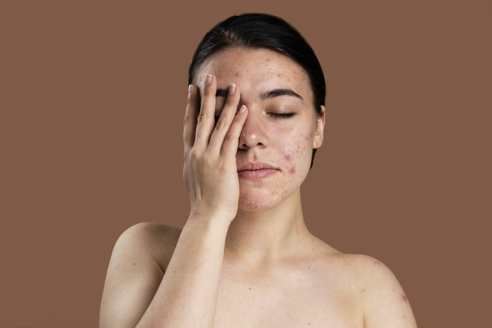 Pigmentation Treatment treatment at Derma Essence Noida