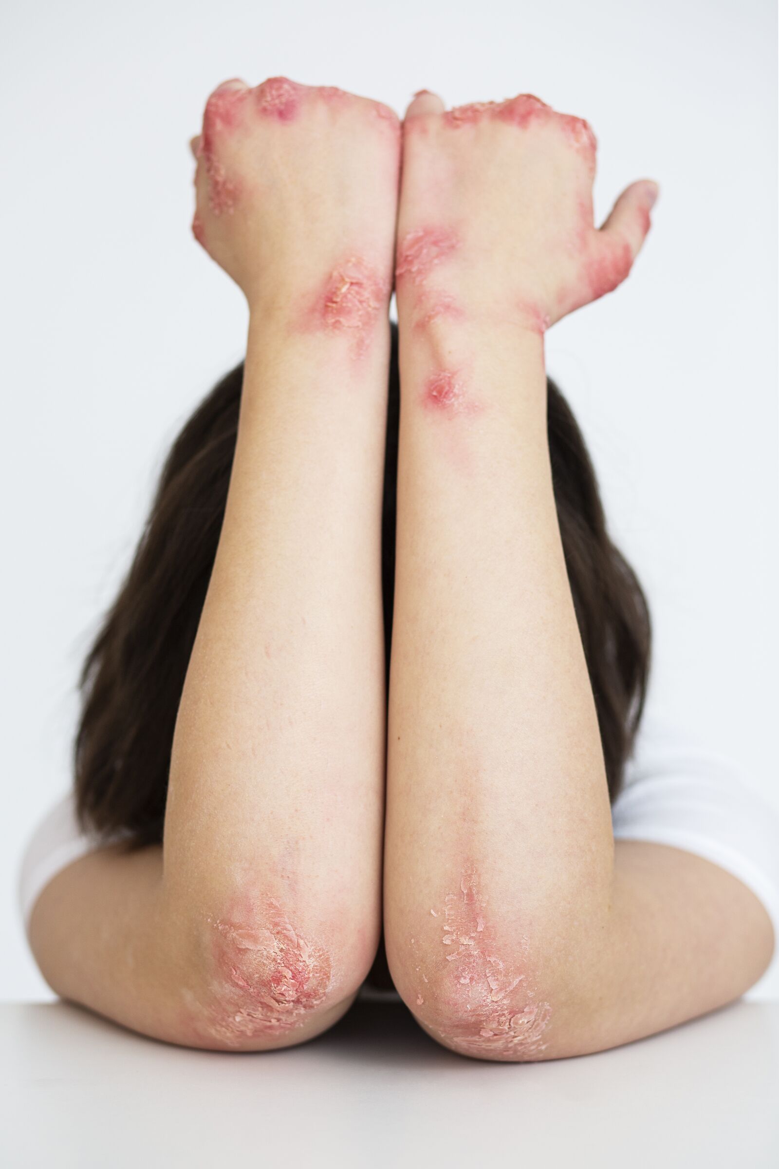 Acanthosis Nigricans treatment at Derma Essence Noida