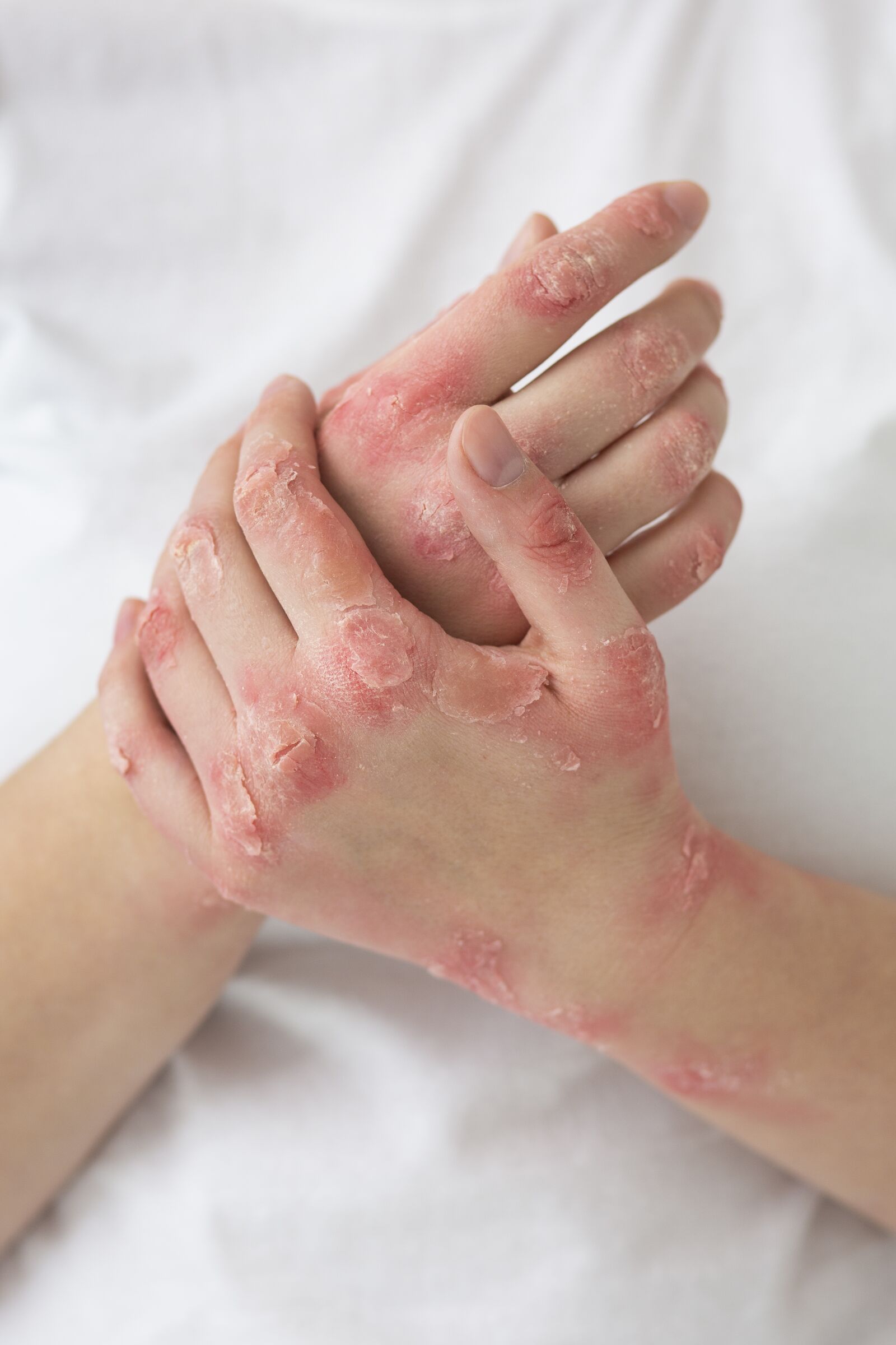 Psoriasis Treatment treatment at Derma Essence Noida