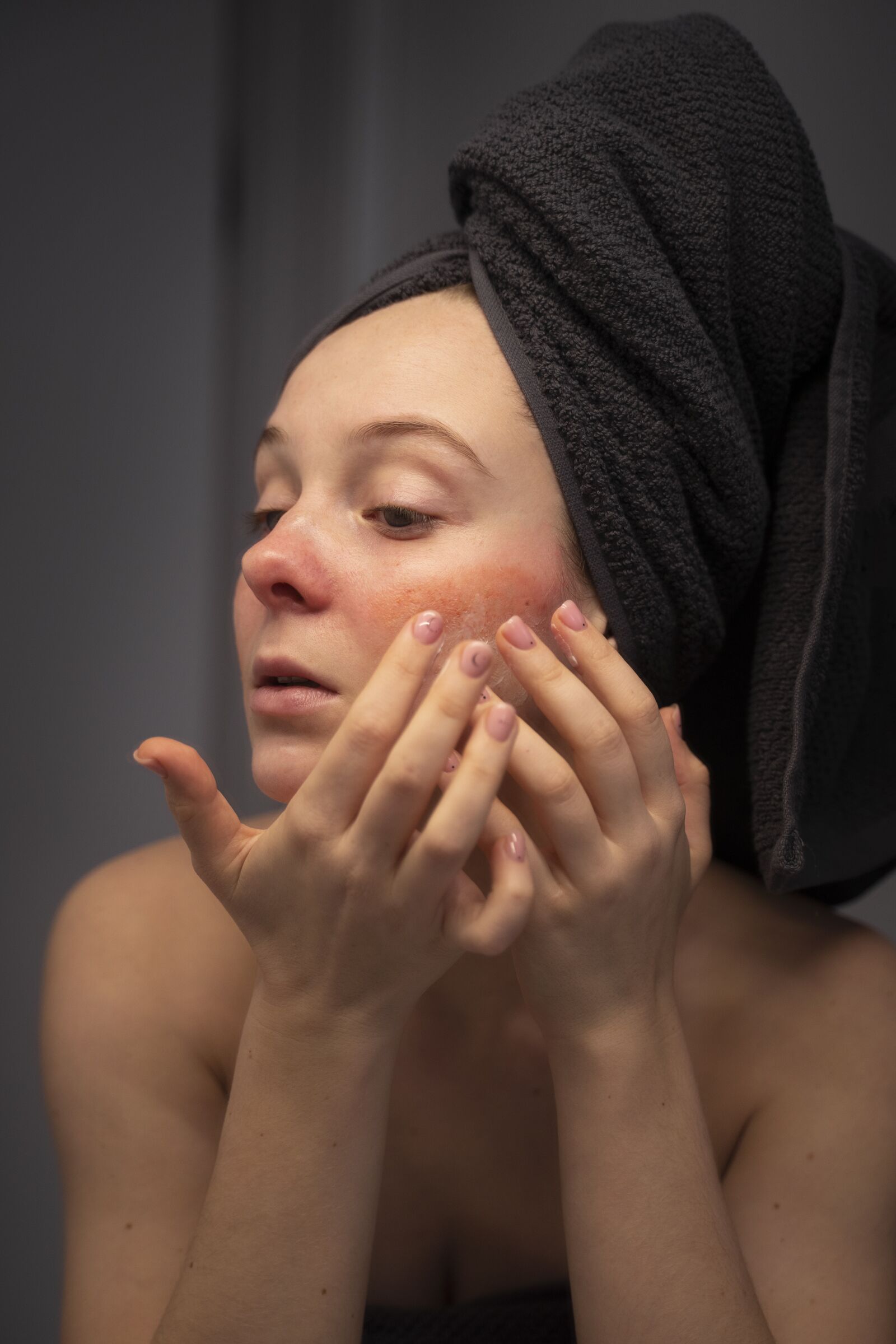 Rosacea treatment at Derma Essence Noida