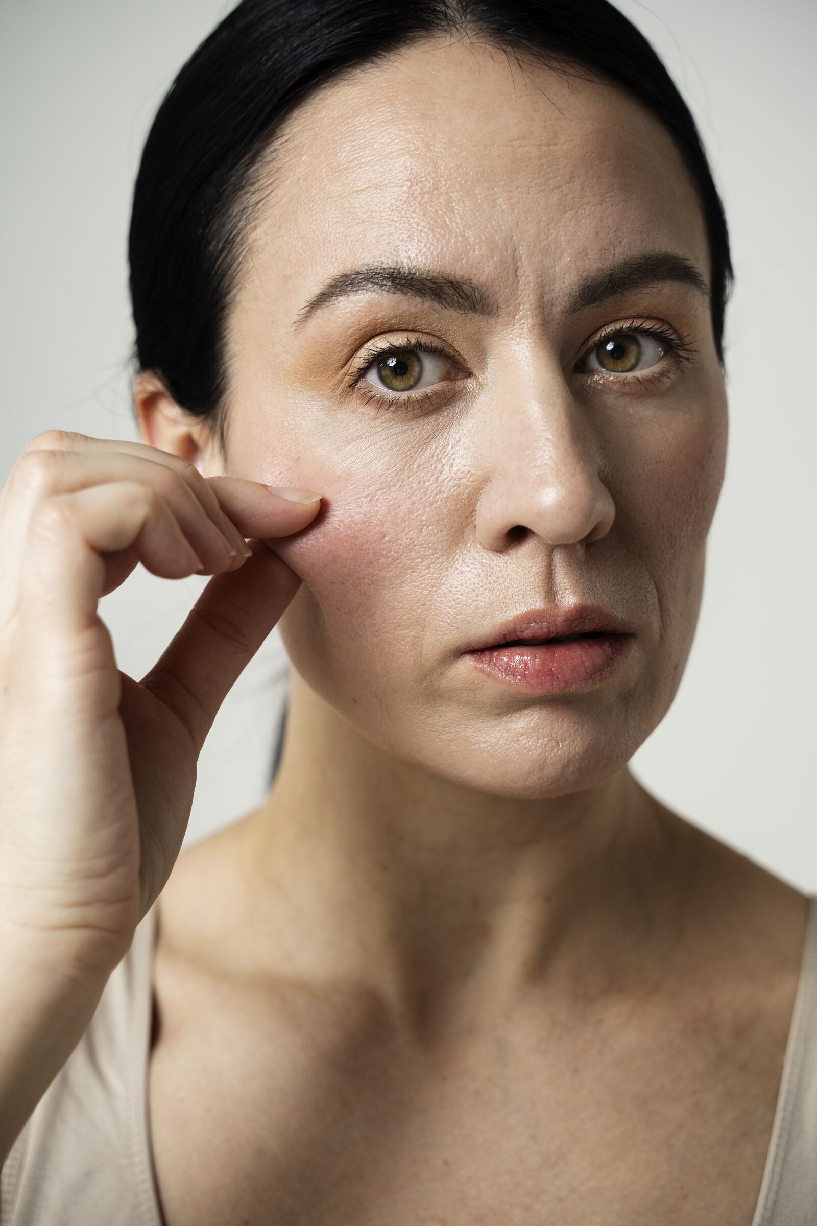 Sagging Skin treatment at Derma Essence Noida