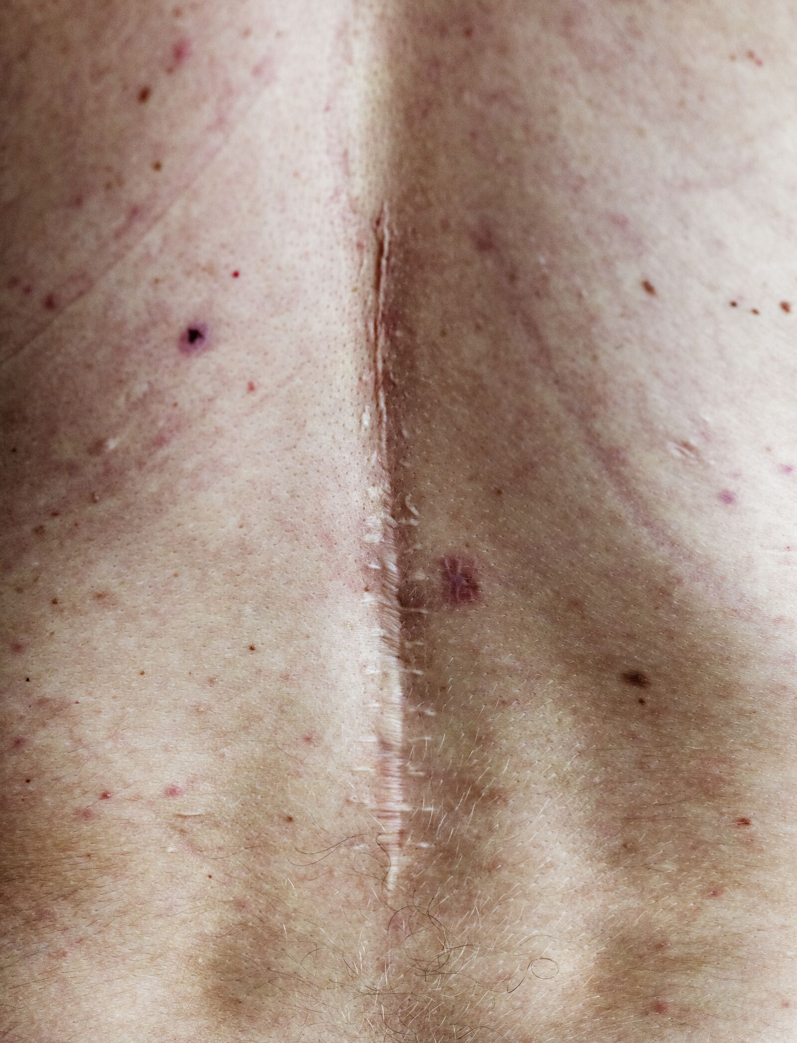 Scars treatment at Derma Essence Noida