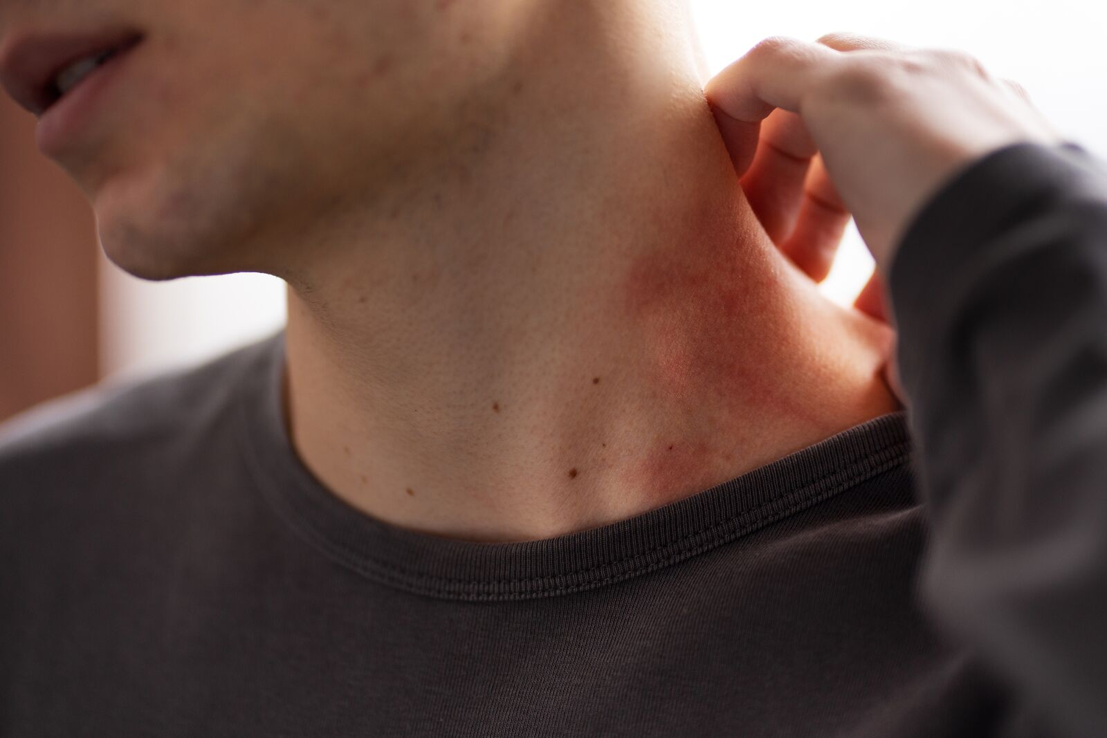 Seborrheic Dermatitis treatment at Derma Essence Noida