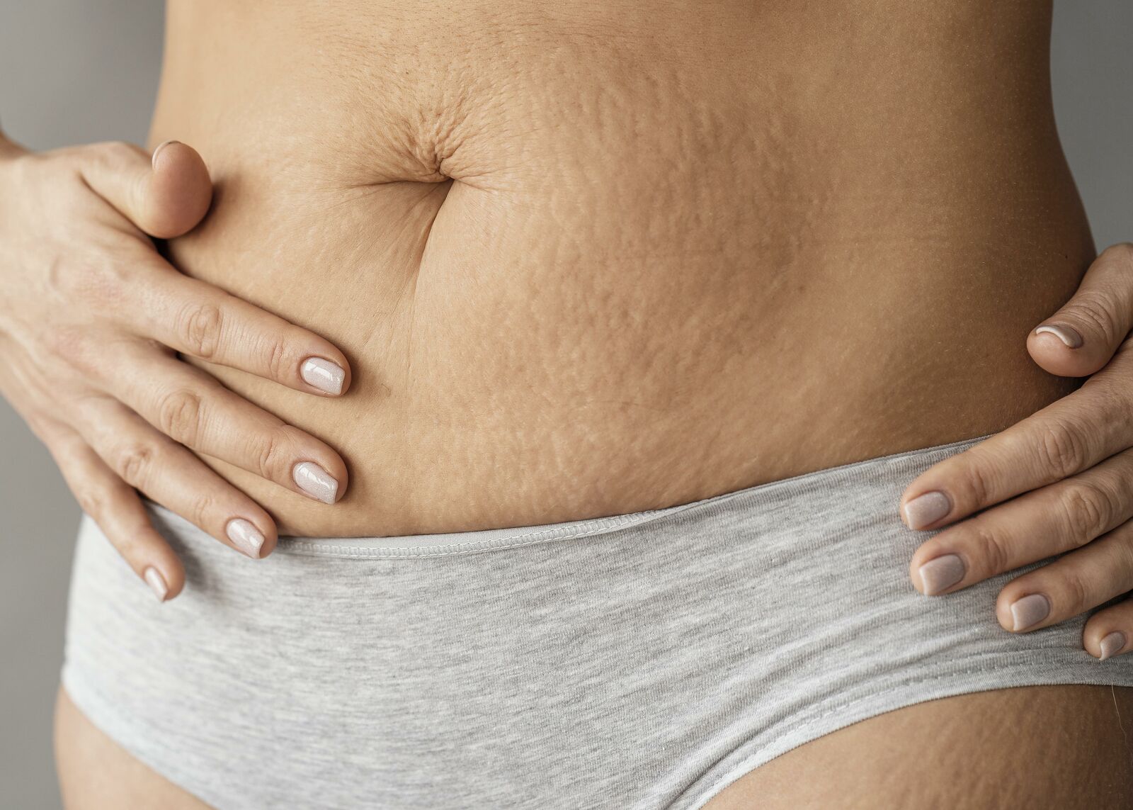 Stretch Marks treatment at Derma Essence Noida