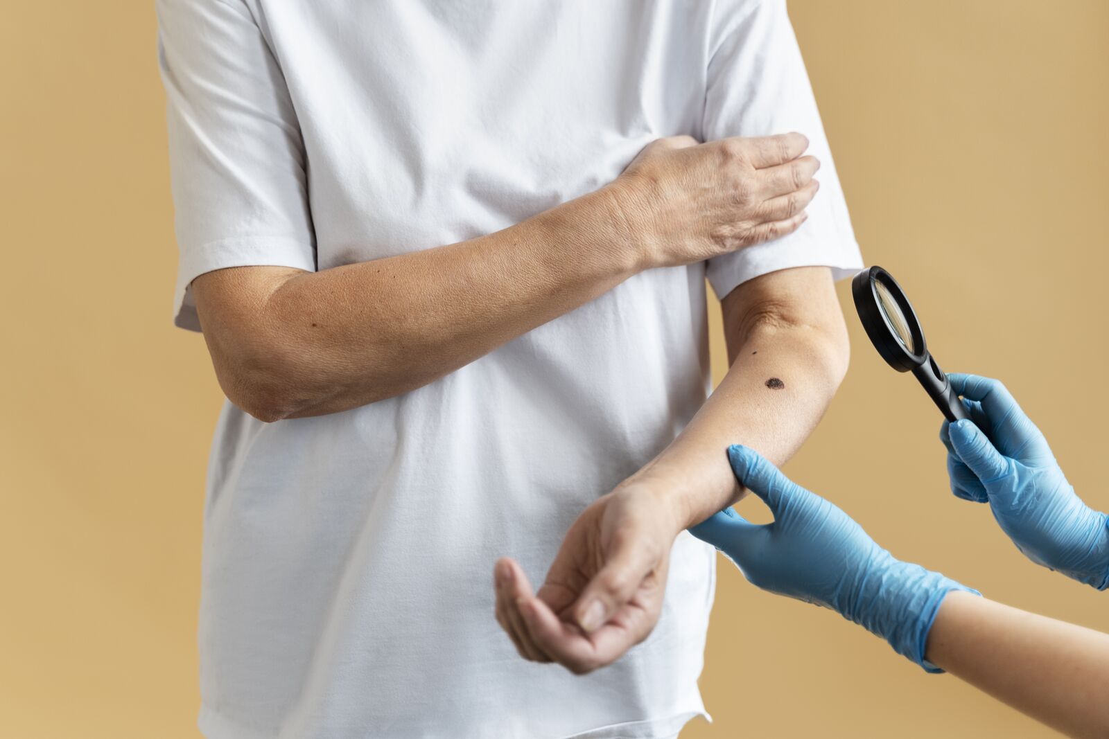 Tinea Treatment treatment at Derma Essence Noida