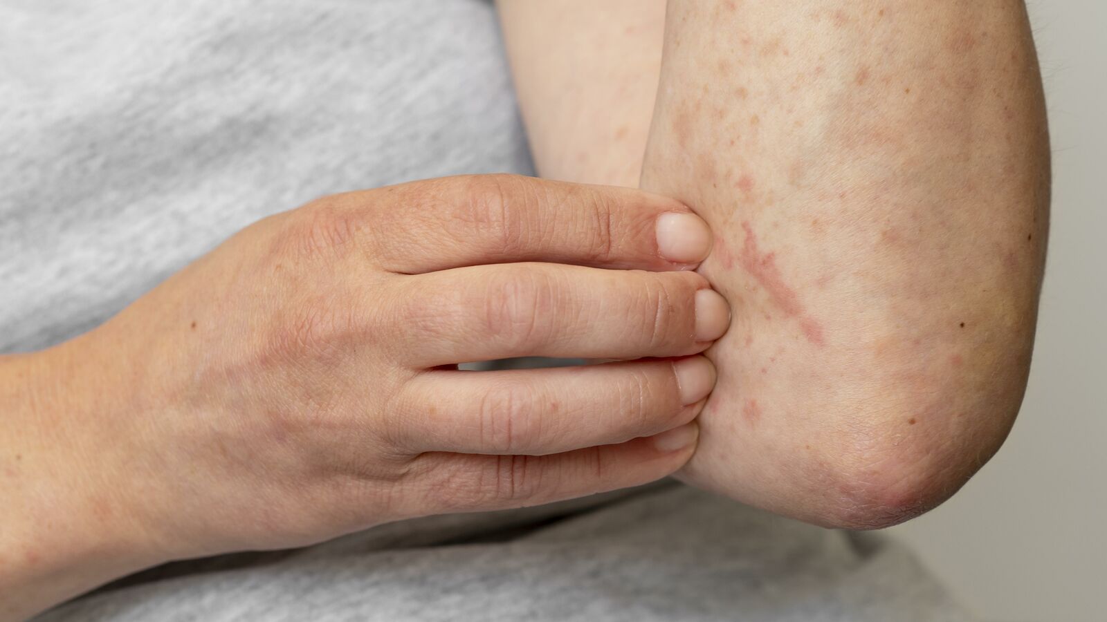 Urticaria treatment at Derma Essence Noida