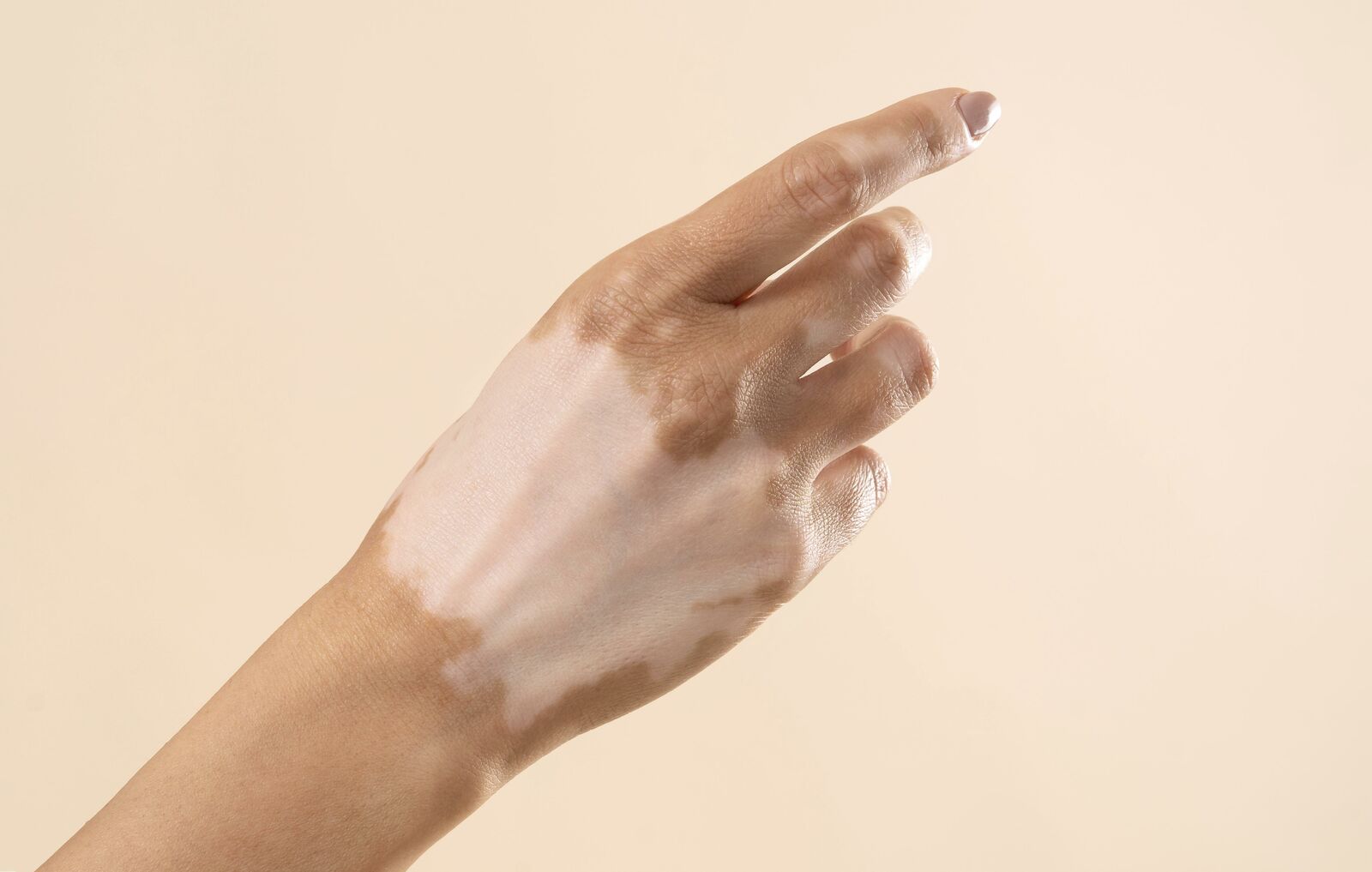 Vitiligo Surgery treatment at Derma Essence Noida