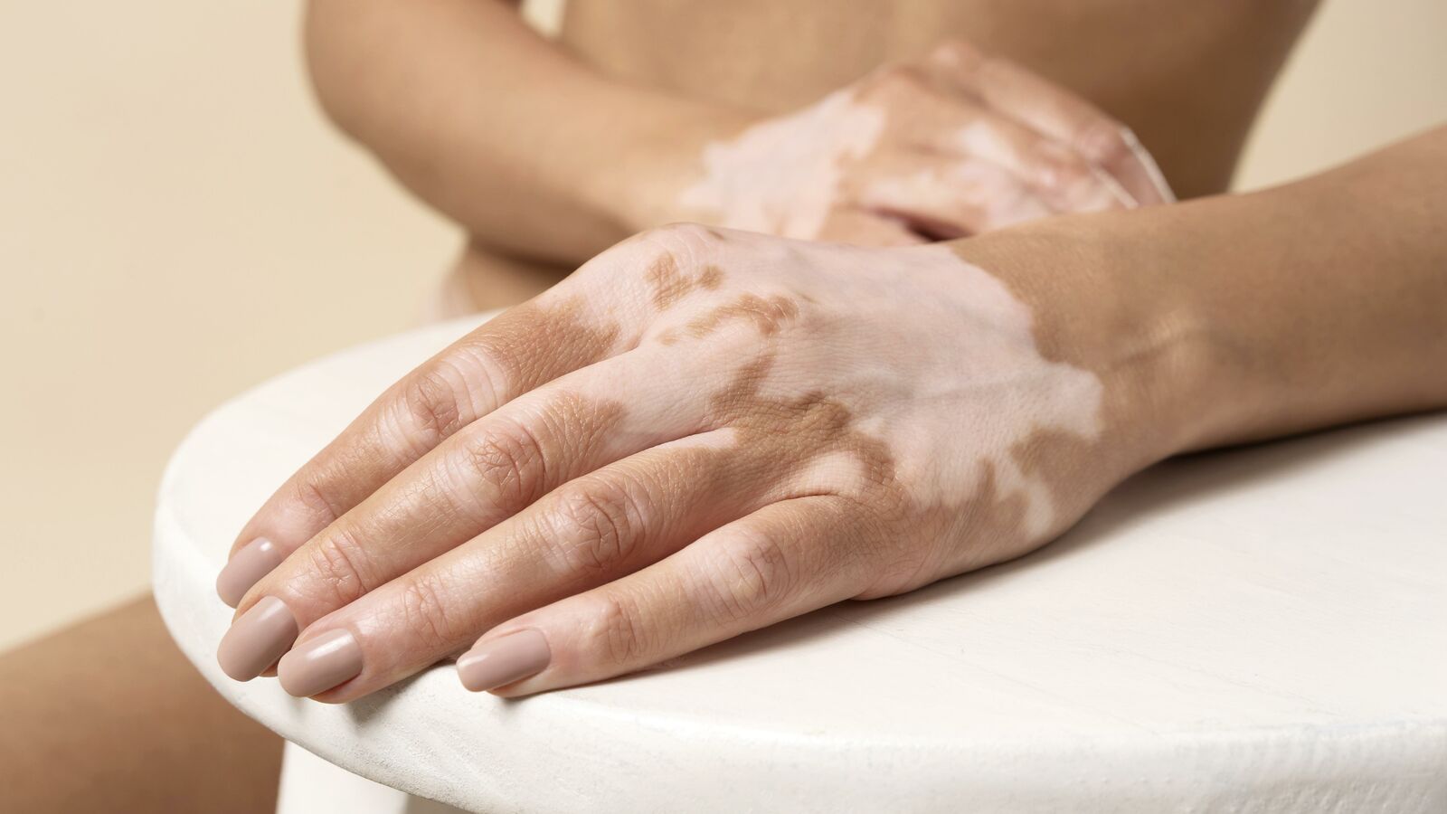 Vitiligo treatment at Derma Essence Noida