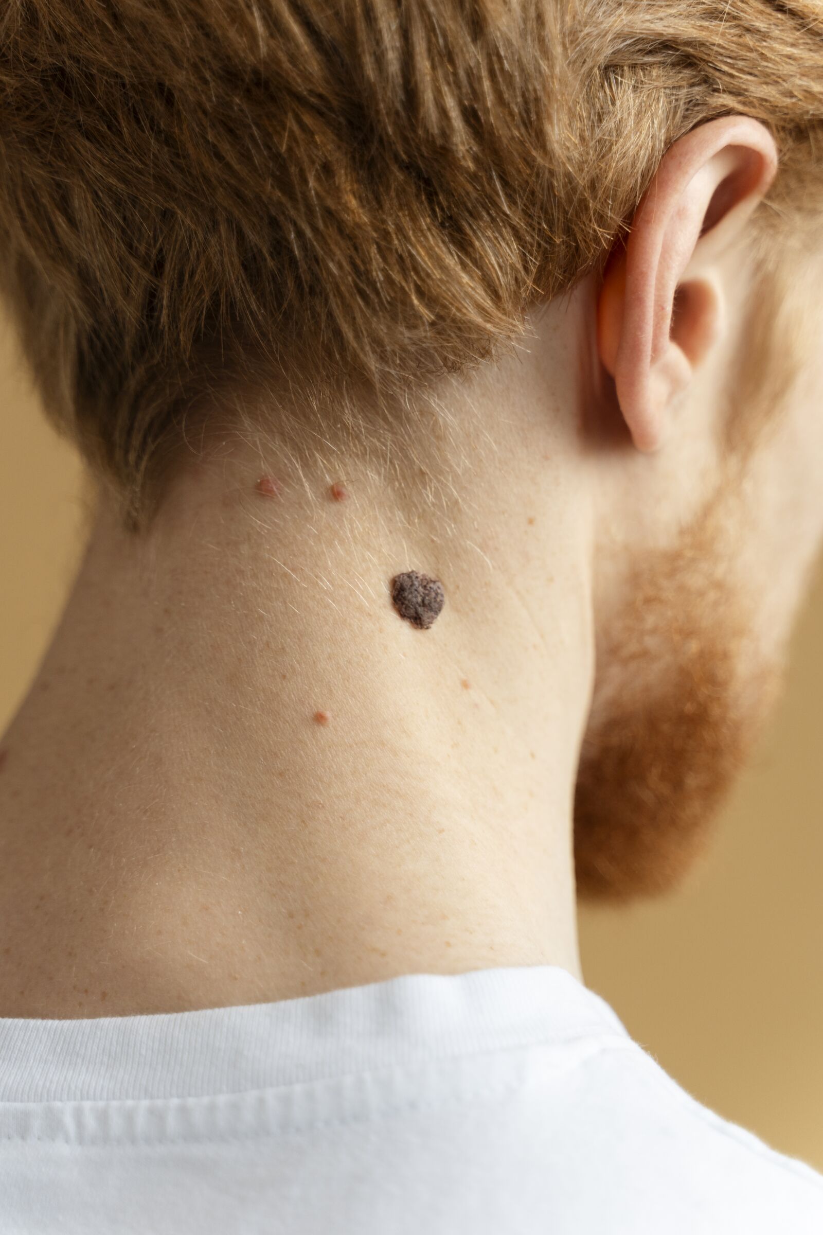 Wart Removal treatment at Derma Essence Noida