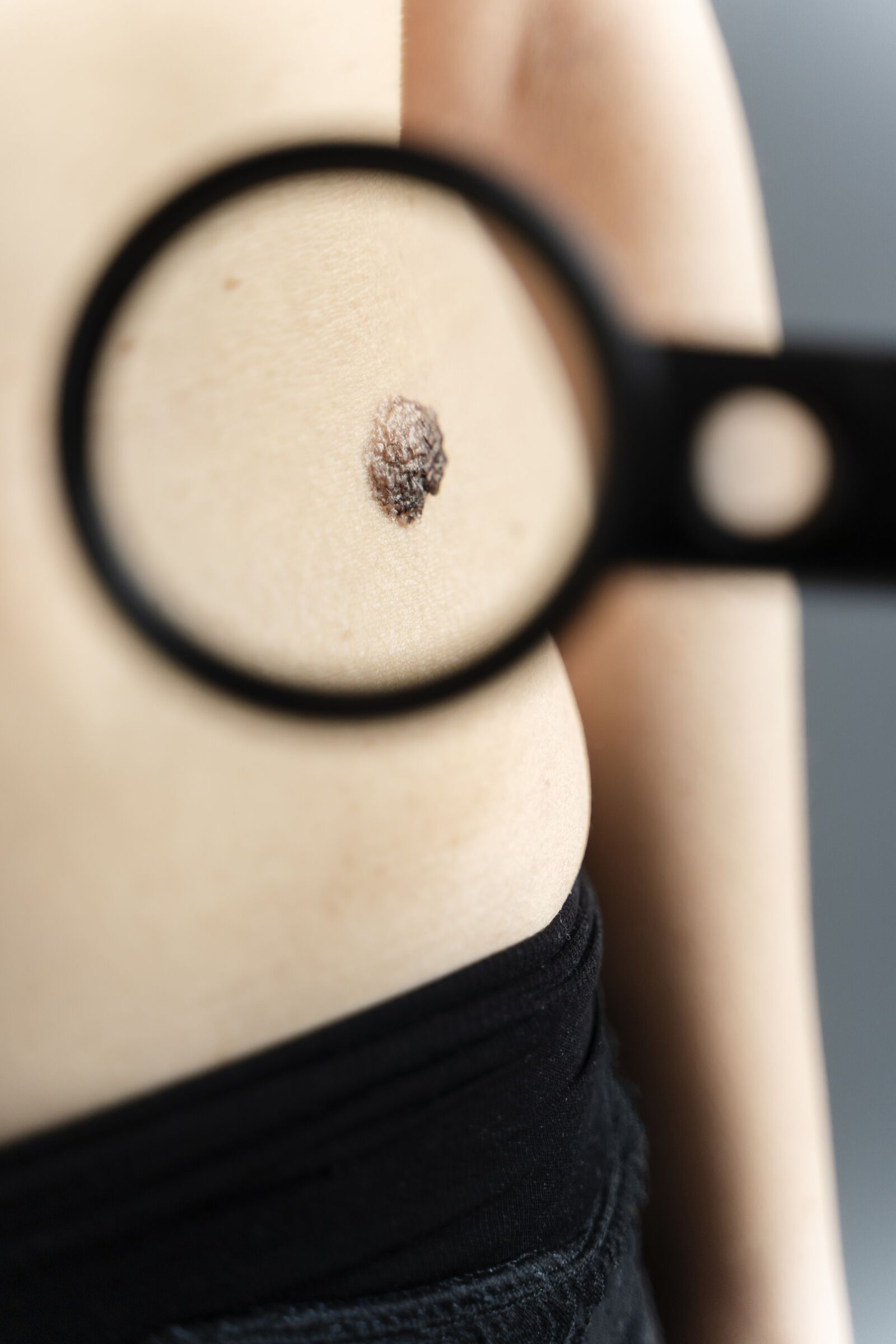 Warts / Skin Tags treatment at Derma Essence Noida