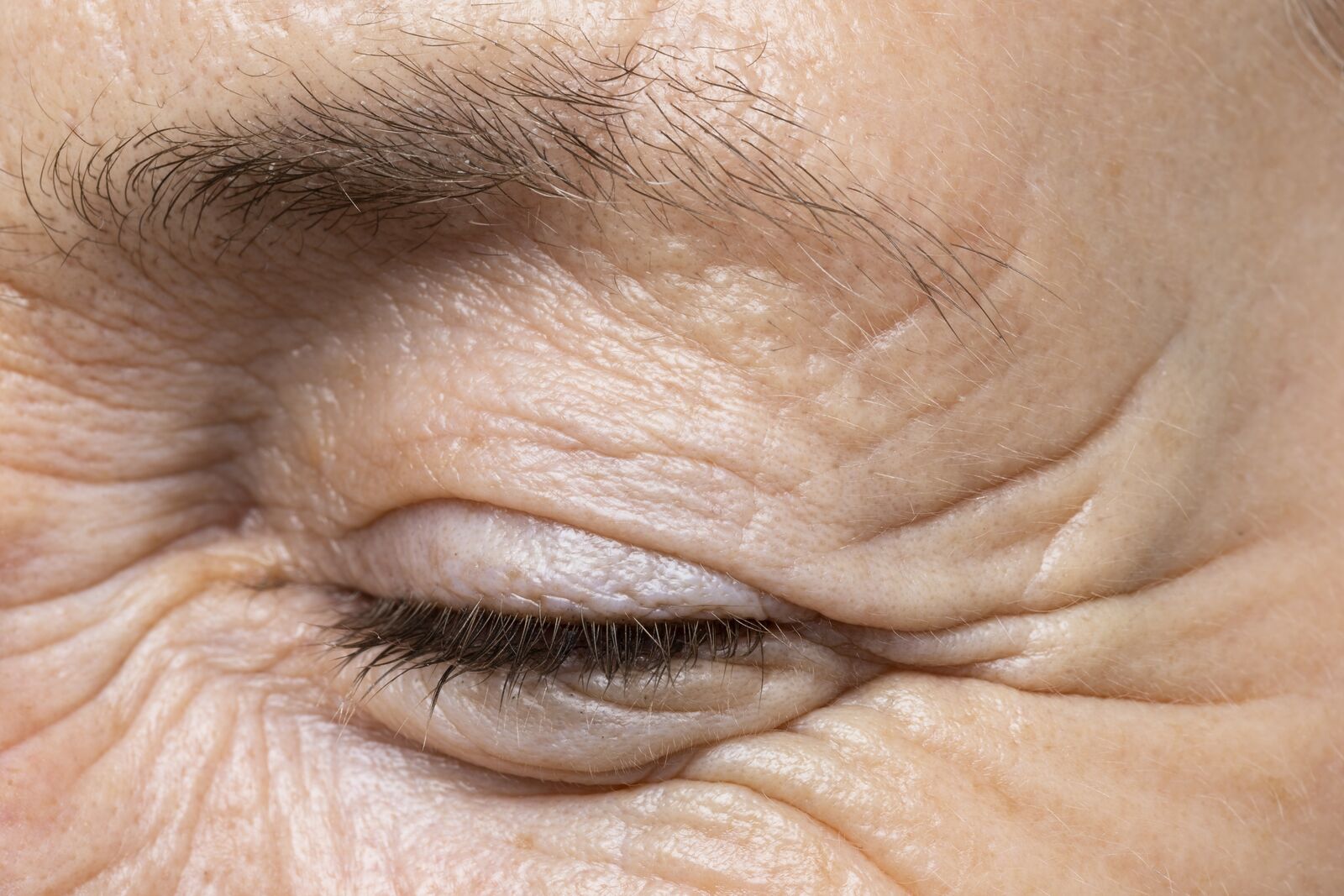 Wrinkle treatment at Derma Essence Noida